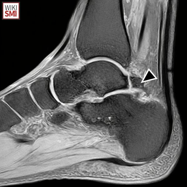 File:OS trignoum MRI.jpeg