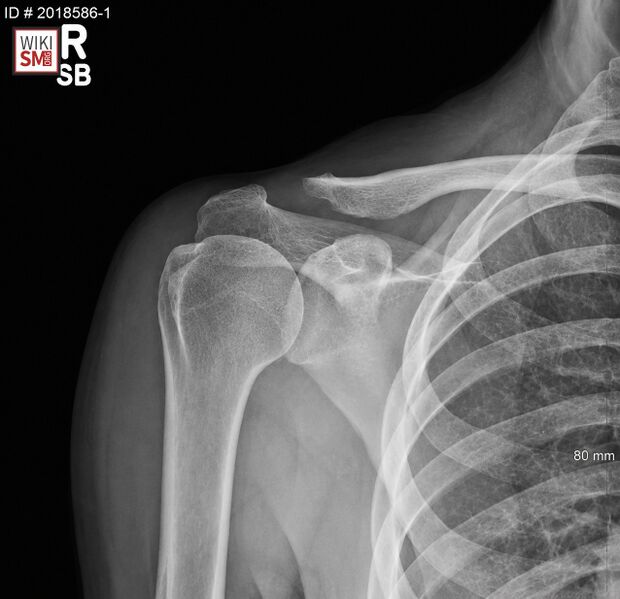 File:Xray Distal Clavicle Osteolysis.jpeg