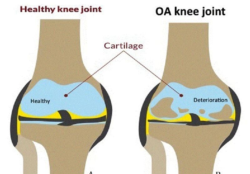 File:Illustration knee articular cartilage.jpg
