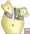 Illustration of scapholunate interosseous ligament anatomy. The drawing depicts a slightly oblique, coronal view of the distal radius, scaphoid and lunate. The scapholunate ligament has been transected to demonstrate its three distinct parts, which include the dorsal (arrowhead), membranous (white arrow) and volar (black arrow) components[1]