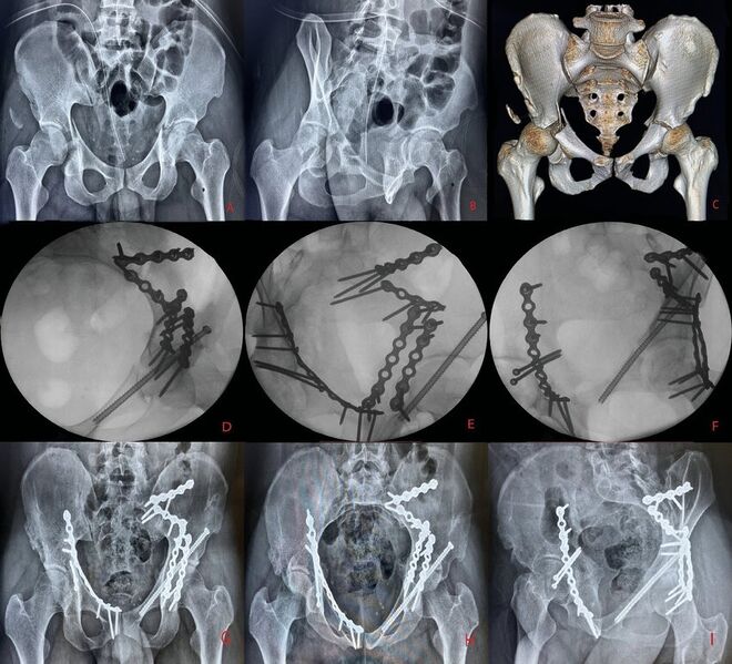 File:Pelvic fracture surgical.jpg