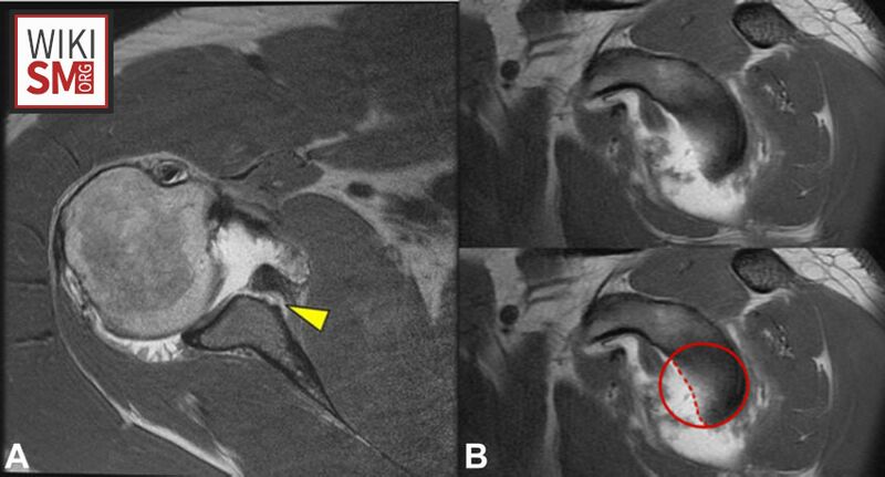File:Bony bankart MRI.jpeg