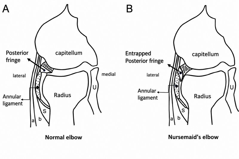 File:Nursemaids Elbow Pathoanatomy.jpg