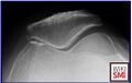 Axial radiograph illustrating medial patellofemoral joint arthritis