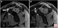 Sagittal PD FS sequence images at different plane levels demonstrate coracoclavicular bursal fluid distension (arrow) with narrowing of the coracoclavicular distance (2.2 mm)[1]