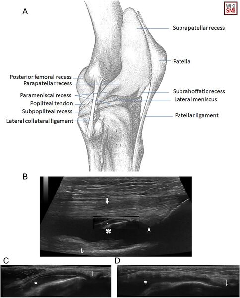 File:Suprapatellar knee anatomy effusion.jpeg