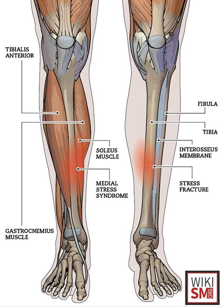 File:Tibial stress fracture illustration.jpg