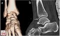 (a) 3D computed tomography (CT) appearance, the black arrow shows the os talotibiale; (b) 2D CT appearance, the white arrow shows the os talotibiale.[2]