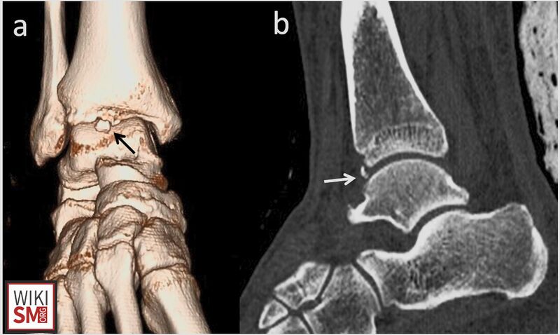 File:CT os talotibiale.jpeg