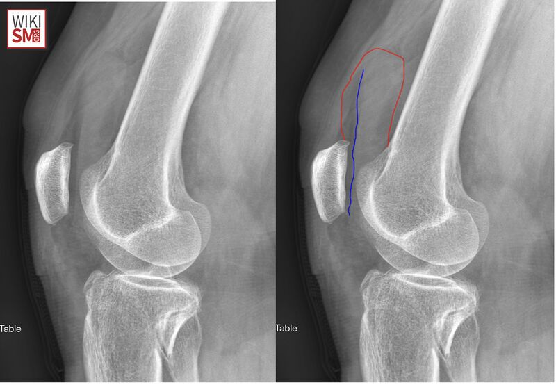 File:Knee xray joint effusion.jpeg