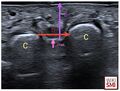Ultrasound imaging of the measurements. C: Metatarsal heads 3 and 4 (M3 and M4). DTML: Deep transverse metatarsal ligament. h: Height: Distance between the DTML and the plantar skin in the middle area between M3 and M4. b: Base: Distance between M3 and M4[3]