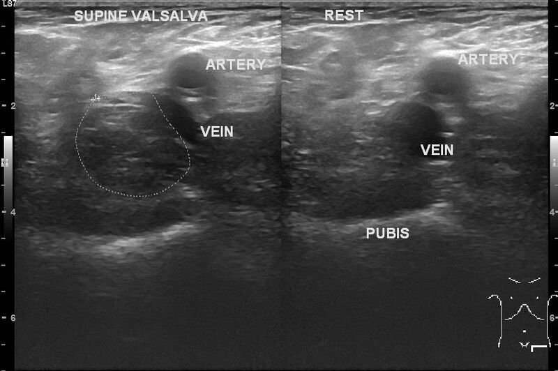 File:Ultrasound femoral hernia.jpg