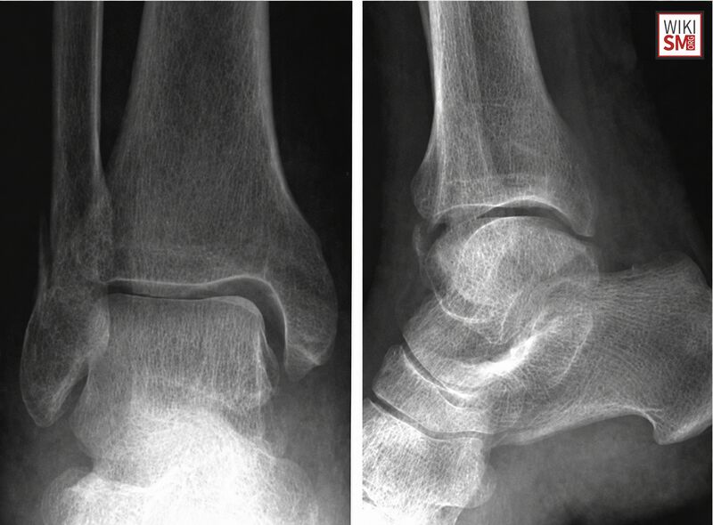 File:Bimal ankle fracture.jpeg