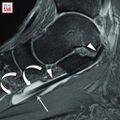 Tenosynovitis of the FHL tendon at the master knot of Henry. Sagittal FS T2-weighted MR image shows loculated fluid (curved arrows) distending the sheath of the FHL tendon (arrowheads). Note the more plantar FDL (thin arrow).[4]