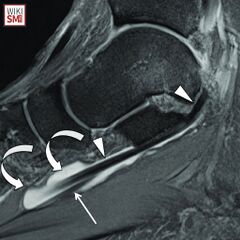 Knot of Henry - WikiSM (Sports Medicine Wiki)