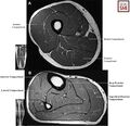 MRI of the compartments of the thigh