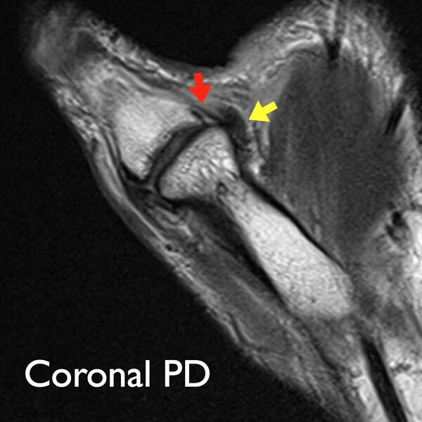 File:Thumb MRI stener lesion.jpg