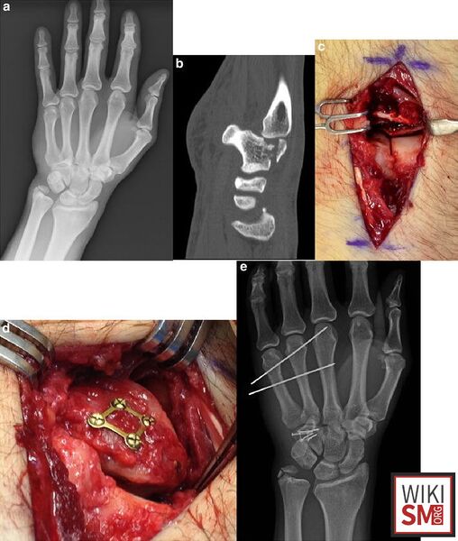 File:Hamate fracture surgery.jpeg