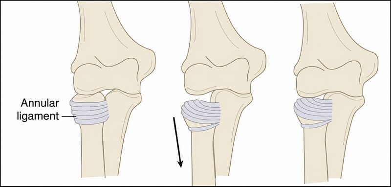 File:Nursemaids elbow annular ligament.jpg