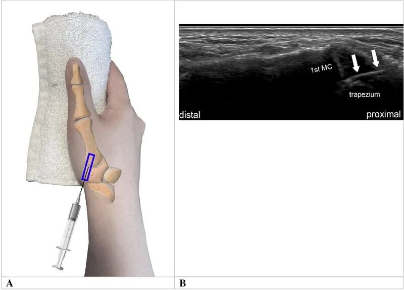 File:1st CMCJ injection ultrasound.jpg