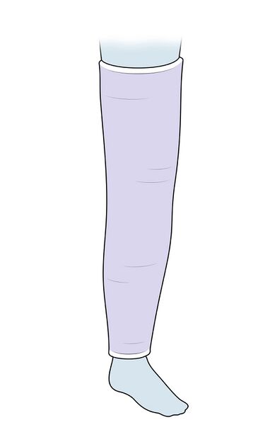 File:Leg cylinder cast illustartion.jpg