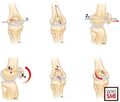 Six degrees of freedom movement of the patella relative to the femorotibial joint[2]