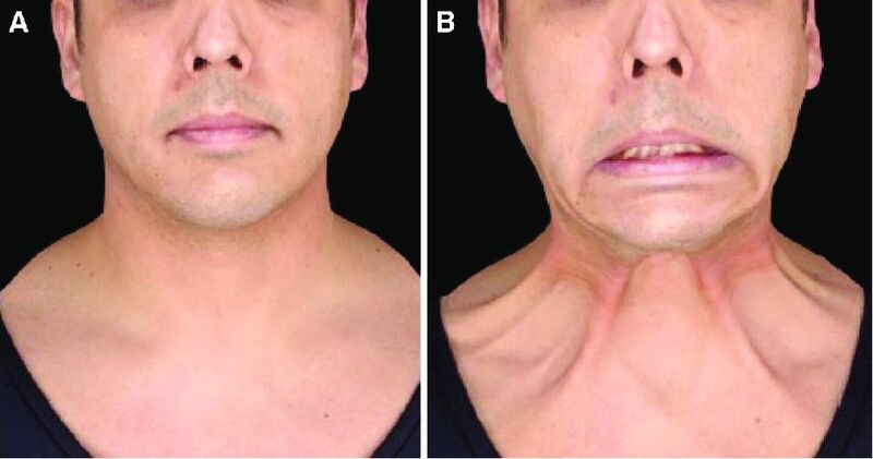 File:Platysma rest contraction.jpg