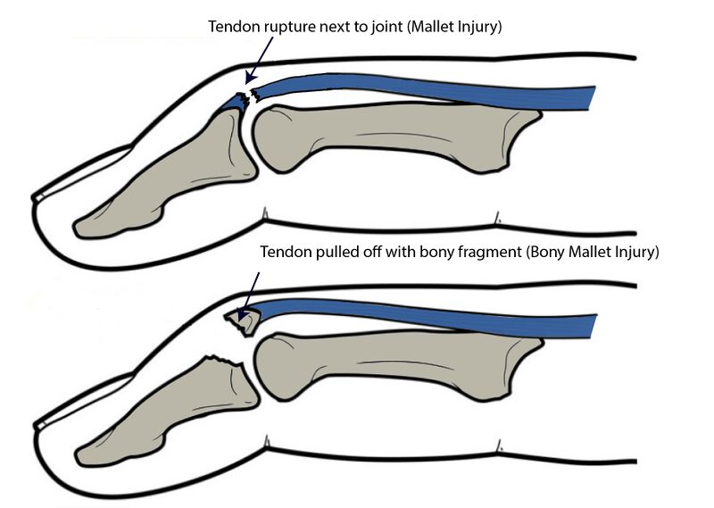 File:Bony mallet injury.jpg