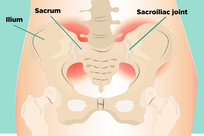 File:Ilustration sacroiliac joint pain.jpg