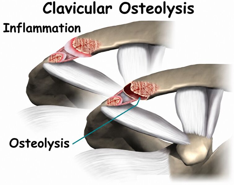 File:Distal Clavicle Osteolysis DCO.jpeg
