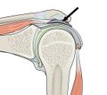 Illustration of the subacromial bursa[1]