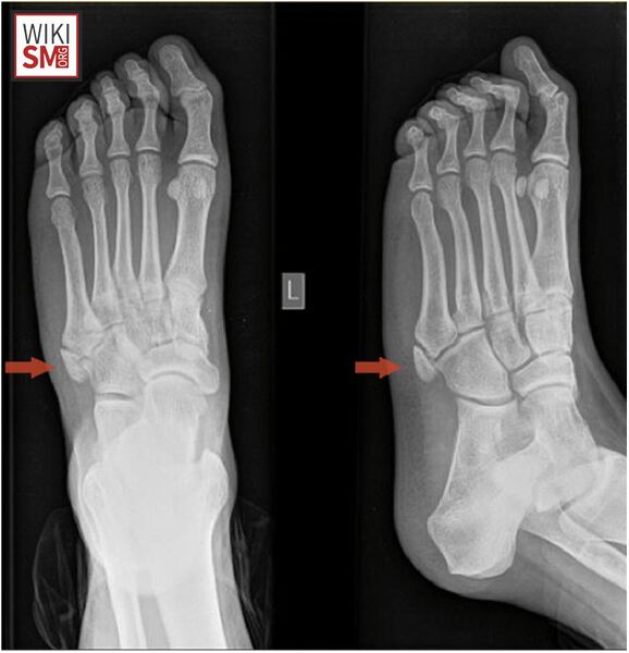 File:Os Vesalianum pedis xray.jpeg