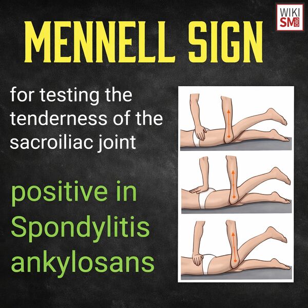 File:Mennell sign ankylosis spondylitis.jpeg
