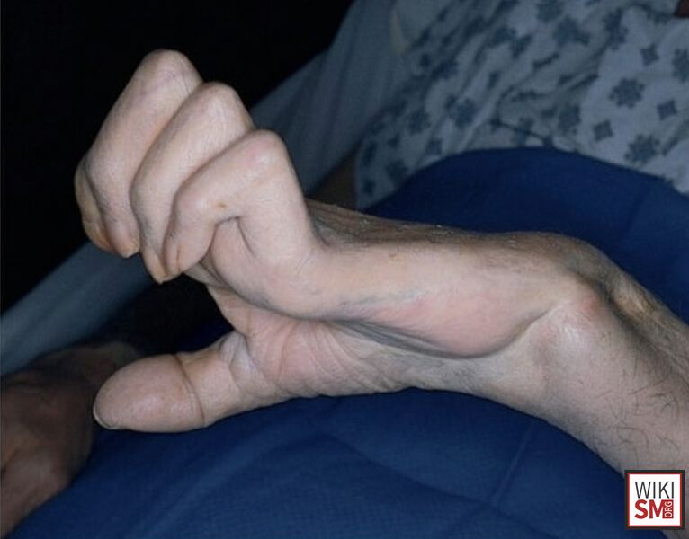 File:Intrinsic minus ulnar neuropathy.jpeg