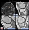 Axial image (C) shows the normal appearance of the menisci, location of sagittal slices (lines 1. and 2.) in B, C and D. Sagittal images show the typical bow-tie configuration of the meniscal body corresponding to line 1 (B) and the opposing triangles of the horns corresponding to line 2 (C and D). Moreover, the horns of the LM are similar in size and shape (C), whereas the posterior horn of the MM is larger than the anterior horn (D)[3]