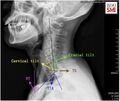 Graphical definition of thoracic inlet angle[2]