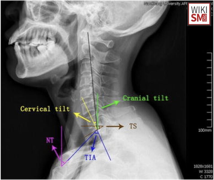 File:Thoracic inlet angle.jpeg