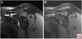 (A, B) Sagittal PD FS sequence images at different plane levels demonstrate coracoclavicular bursal fluid distension (arrow) with narrowing of the coracoclavicular distance (2 mm)[1]