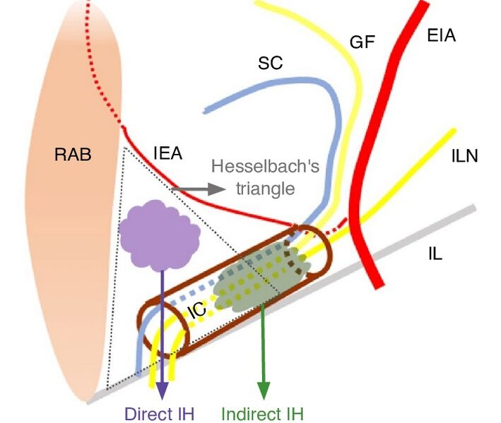 File:Direct indirect inguinal hernia.jpg