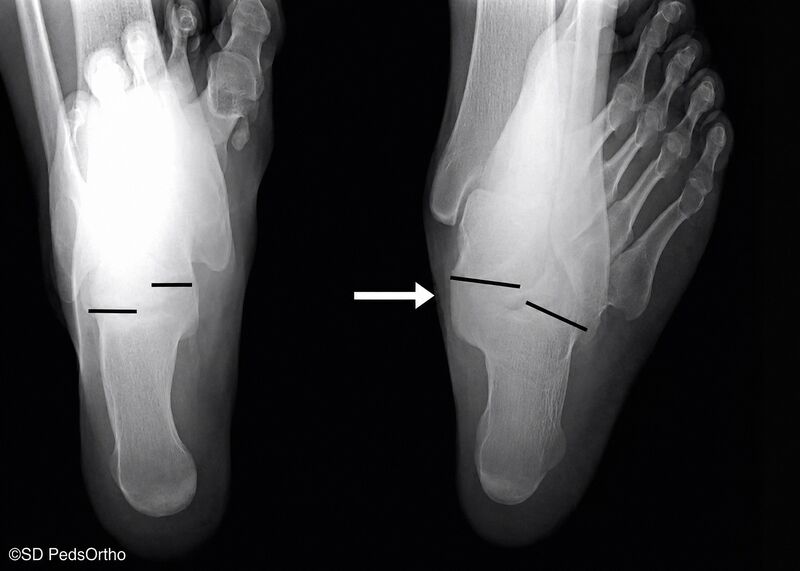 File:Harris heel view.jpg