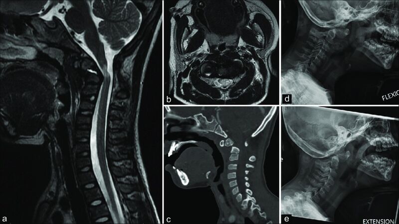 File:MRI atlanto axial instability.jpg
