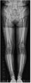 A full-length lower limb x-ray radiograph[2]