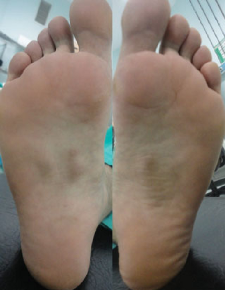 File:Plantar fibromas clinical example.png