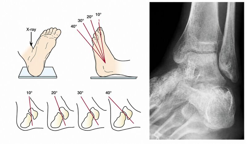File:Broden view calcaneus.jpg