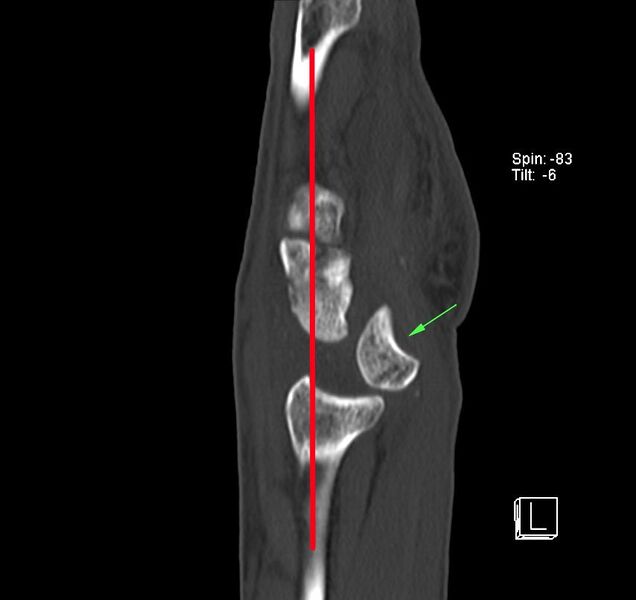 File:Wrist CT Lunate Dislocation.jpg