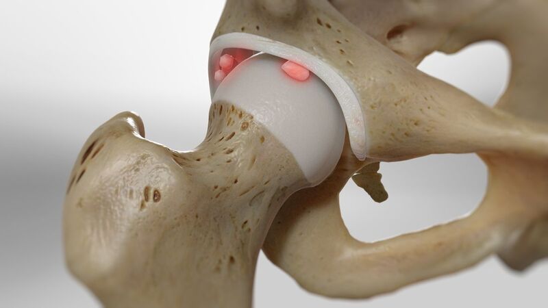 File:Loose body hip joint.jpg