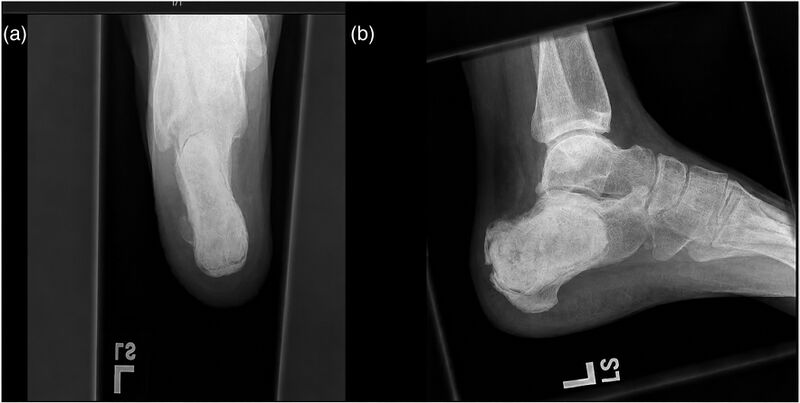 File:Harris view calcaneus fracture.jpg