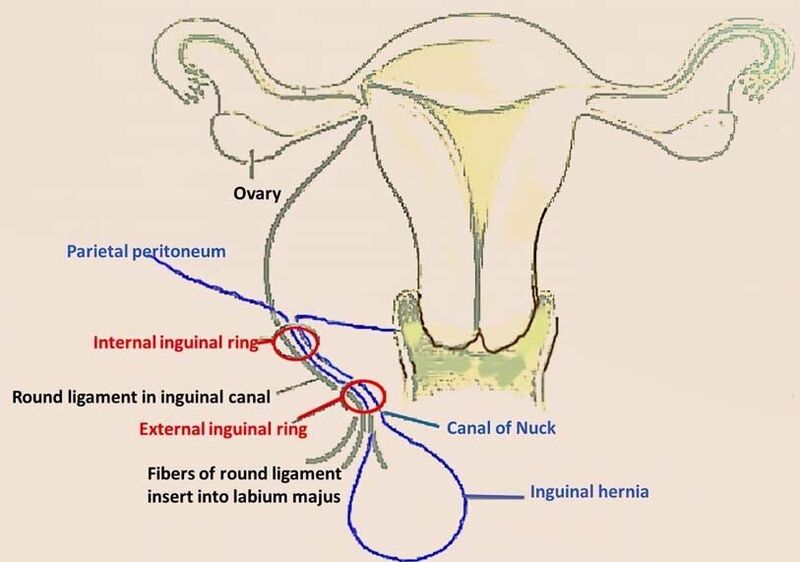 File:Indirect inguinal hernia.jpg