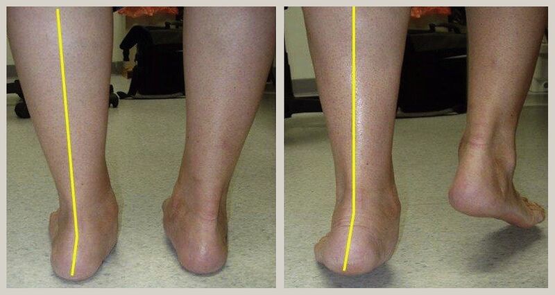 File:Tarsal coalition clinical exam.jpg