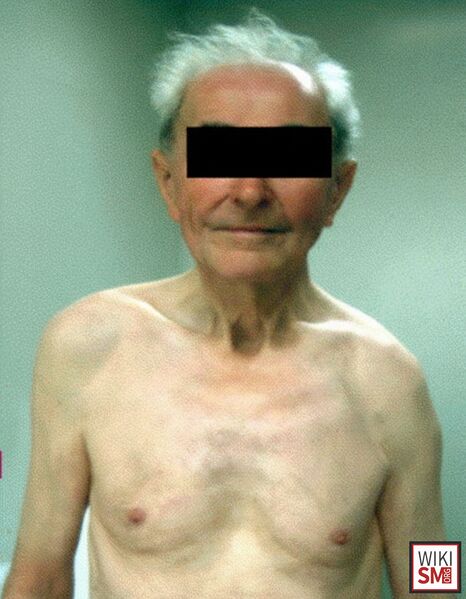 File:Floating shoulder clinical picture.jpeg